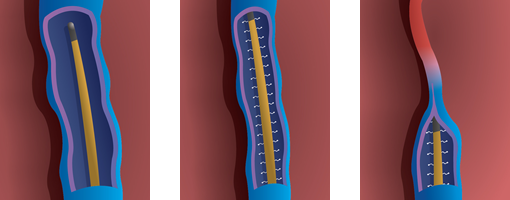 VNUS Procedures